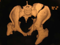 pelvis_sidney1